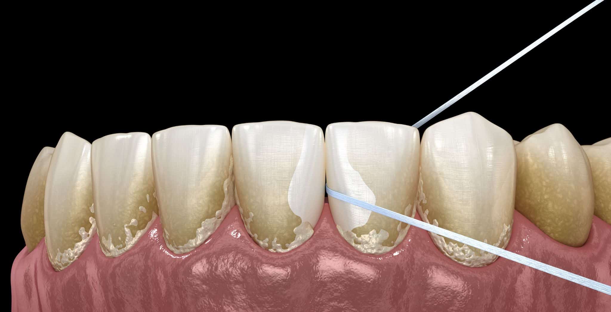Removing dental plaque, How to remove plaque from teeth, Dental plaque removal tips, Preventing plaque buildup, Plaque cleaning techniques, Oral hygiene for plaque control, Natural ways to remove plaque, Professional dental cleaning, Tooth brushing for plaque removal, Flossing to reduce plaque, Home remedies for dental plaque, Maintaining plaque-free teeth, Dental care for healthy gums